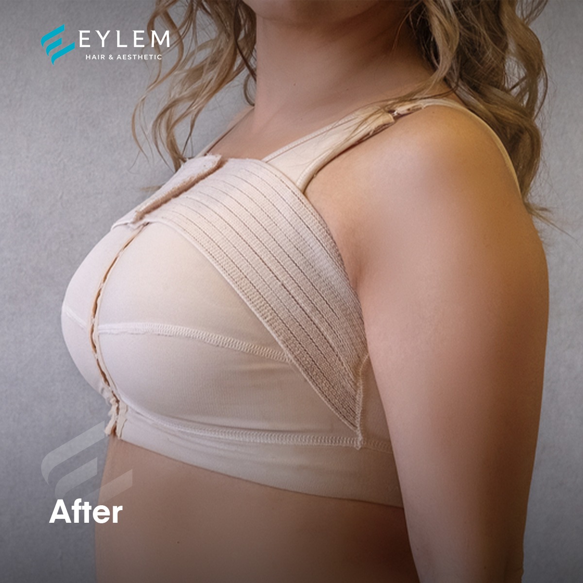 Breast Augmentation In Turkey - Eylem clinic
