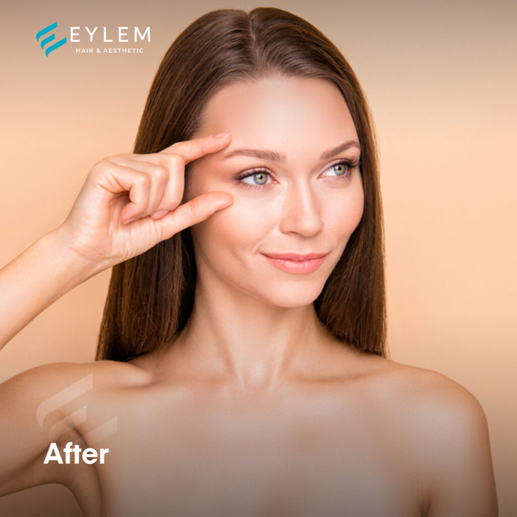 Botox treatment in Turkey - Eylem clinic