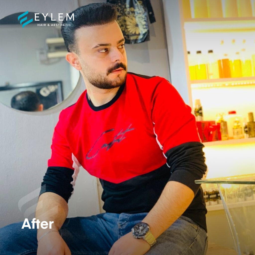 Hair Transplant In Turkey - Eylem clinic