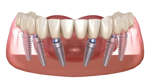 All-on-6 Dental Implants: Contemporary Tooth Restoration