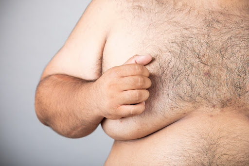 The difference between gynecomastia and fat in the chest area