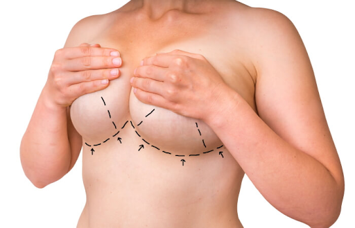 Do scars remain after breast lift operations?