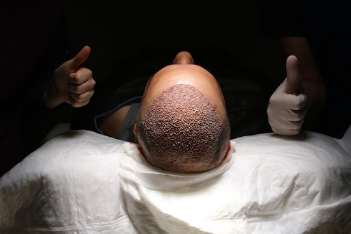 Are hair transplant operations in Turkey successful?