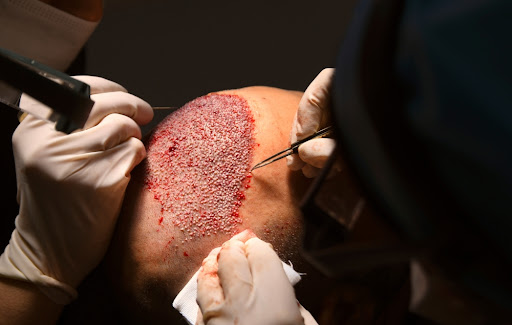 DHI Hair Transplant Procedure