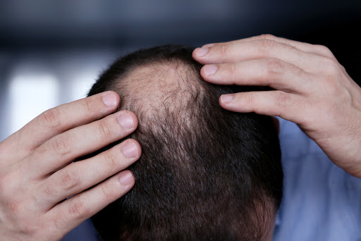 Hair transplantation process steps in Eylem clinic in turkey