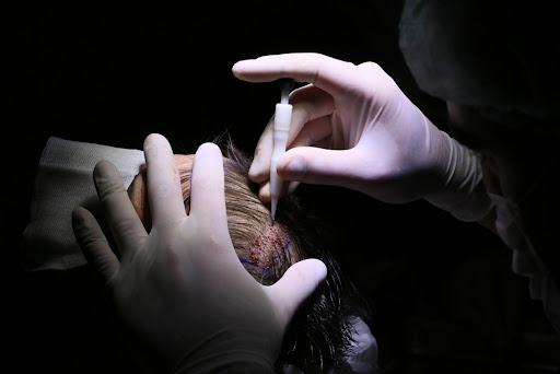 Sapphire FUE hair transplant Procedure: Benefits, Side Effects, How It done