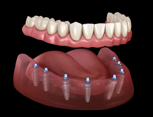 All-on-8 Dental Implants in Turkey