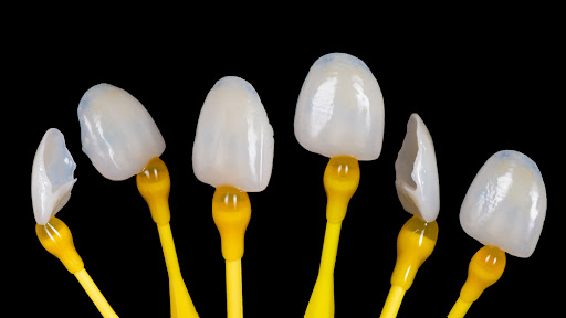 Dental veneers: Candidates, Steps & Advantages