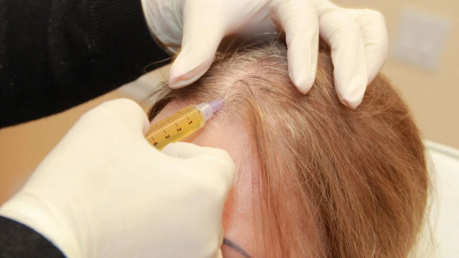 What is the hair mesotherapy injection technique?