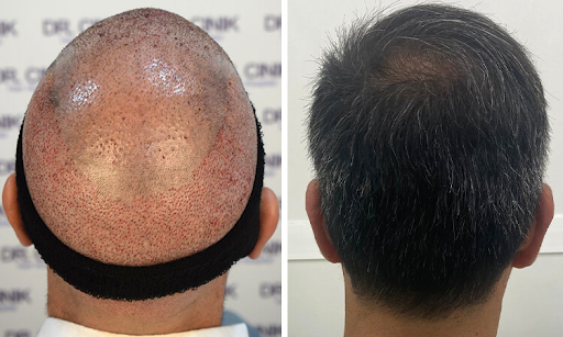 زراعة الشعر الفاشلة: هل يمكنك تجنبها أو إصلاحها؟0