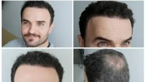 Why Türkiye for a hair transplant? 3