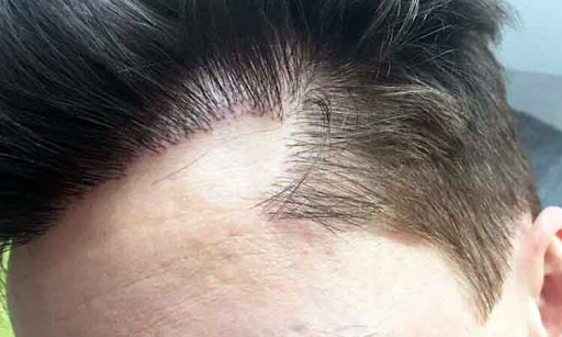 زراعة الشعر الفاشلة: هل يمكنك تجنبها أو إصلاحها؟4