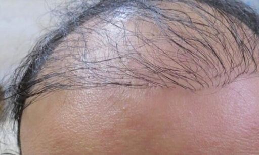 زراعة الشعر الفاشلة: هل يمكنك تجنبها أو إصلاحها؟5