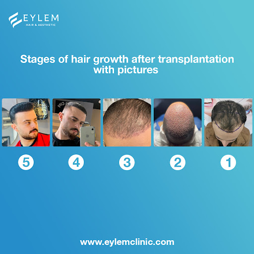 What are the stages of hair growth after transplantation?