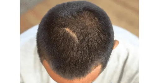 ماهي أسباب فشل عملية زراعة الشعر وماهي الاثار الجانبية؟ 1