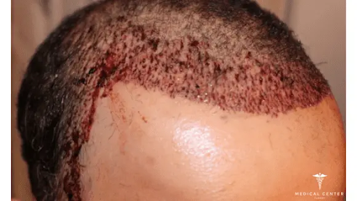 ماهي أسباب فشل عملية زراعة الشعر وماهي الاثار الجانبية؟ 5