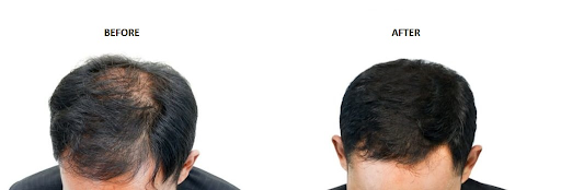 متى ينمو الشعر مرة أخرى بعد زراعة الشعر؟ 0