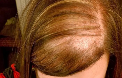 Do you suffer from hair loss and thinning?