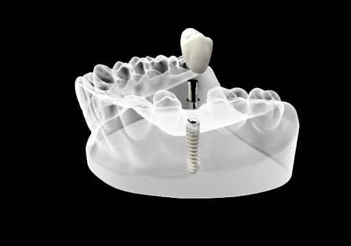 Zirconia Dental Implants in Turkey