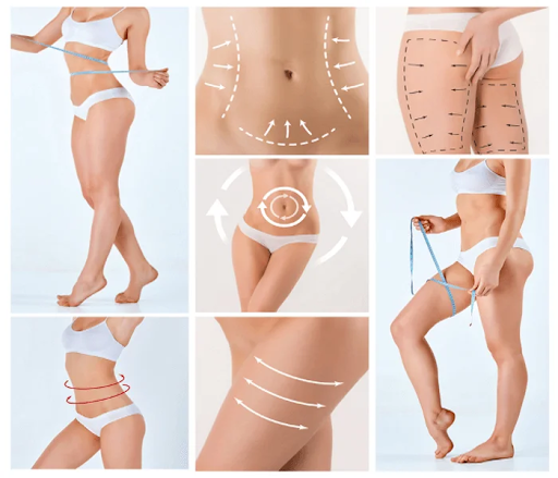 10 things to know before liposuction