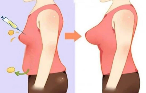 breast augmentation with fat injection