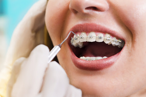 Clear orthodontics: a cosmetic treatment with many advantages