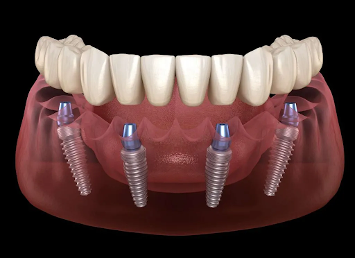 All-on-4 Dental Implants in Turkey